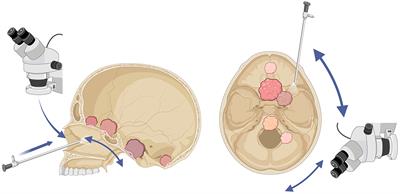 Editorial: Update in endoscopic and transcranial approaches for skull base meningiomas